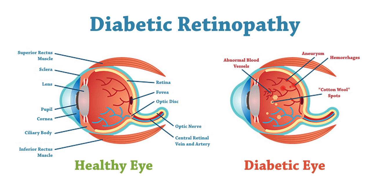 Retinopathy Retinopathy